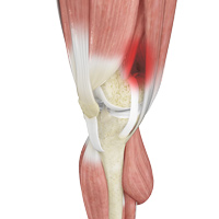 Treating Iliotibial Band Syndrome in Plano, Frisco, McKinney and Allen