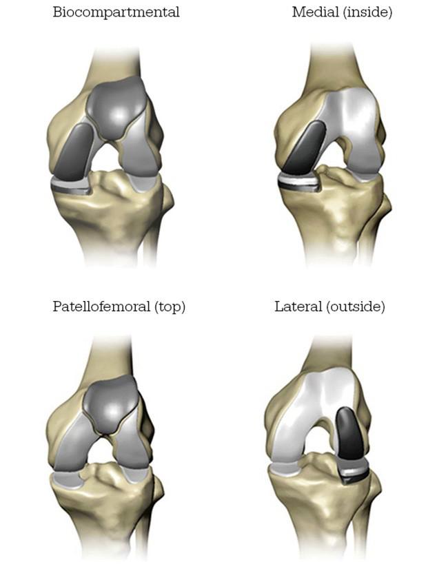 MAKO Robotic Partial Knee Replacement
